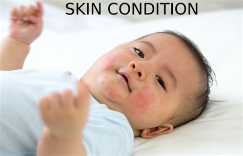 Skin Conditions Explaining Skin Diseases Disorders And More