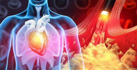 Both Types Of Cardiovascular Disease Cvd Linked To Higher Risk Of