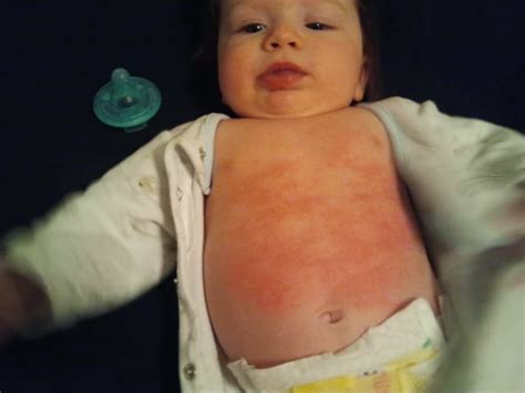 Rash On Babies Face Pictures Photos