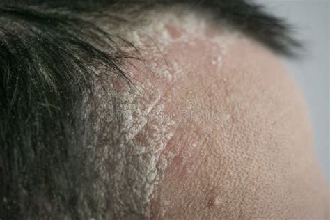 Psoriasis On The Hairline And On The Scalp Close Up Dermatological