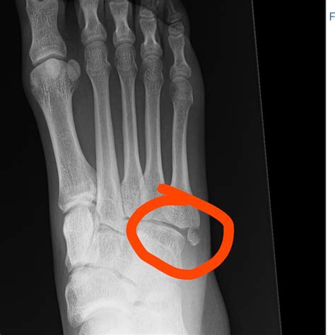 5th Metatarsal Avulsion Fracture Did This On The 15th Of February My