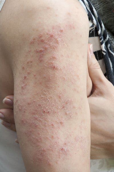 Viruses That Cause Skin Rashes Livestrongcom