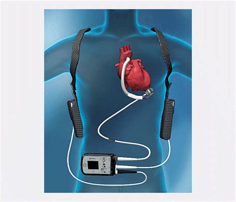 The Promise Of Ventricular Assist Devices Vads Mass General