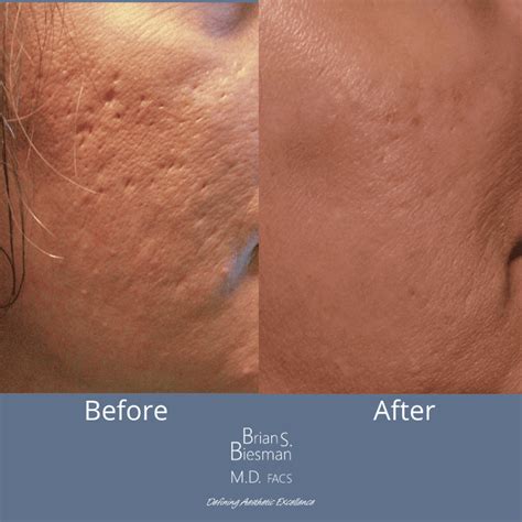 How To Treat The Different Types Of Acne Scars Brian S Biesman Md