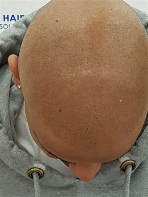 Scalp Micropigmentation For Bald Spots Carolina Scalp Center