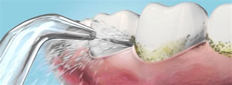 Détartrage Dentiste à Prix Abordables Clinique Dentaire Implantcenter
