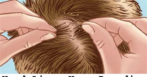 Head Lice Home Remedies For Head Lice And Their Eggs Natural Ways