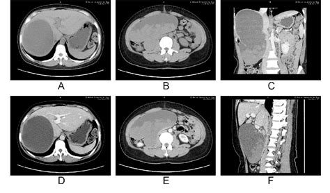 Figure 1 From Rare Ct And Mr Image Findings Of Hepatic Cystic