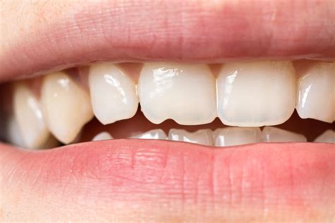 Desgaste Dental Las Causas Que Lo Provocan Adoratrices