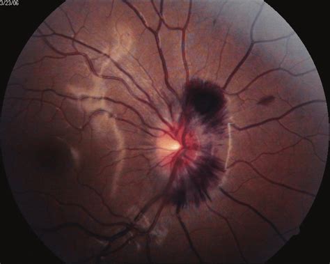 The Patients Fundus Photograph At The First Visit Shows Preretinal