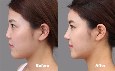 How To Get The Perfect Nose Medcare Spainmedcare Spain