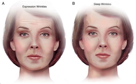 Does Sleeping On Your Side Cause Wrinkles Botox® And JuvÉderm® Fillers