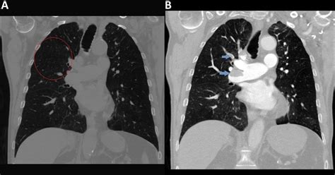 Eighty Five Year Old Man With Mosaic Attenuation On Chest Imaging Bmj