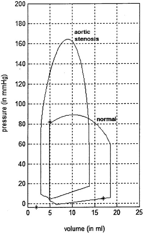 Simulated Left Ventricular Pressure Volume Loops With And Without