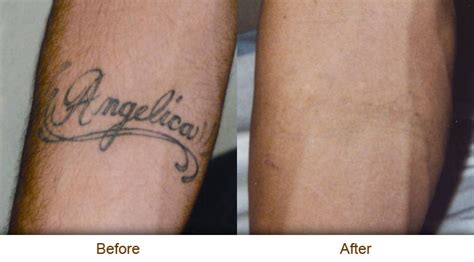 As the tattoo pigment particles are too large to be removed from the skin during filtering, they are permanent, and most previous tattoo removal treatments removed the top layer of skin and left a scar. Natural Tattoo Removal: Natural Tattoo Removal Price