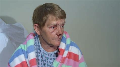 Woman Details Terrifying Coyote Attack In Kingsbury New York Abc7 New York