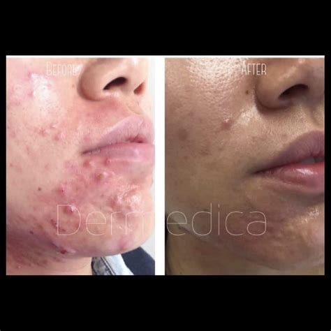 Acne And Acne Scarring Before And After Photos Dermedica