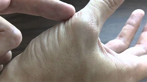 Recognizing Thumb Muscle Atrophy Carpal Tunnel Syndrome Youtube