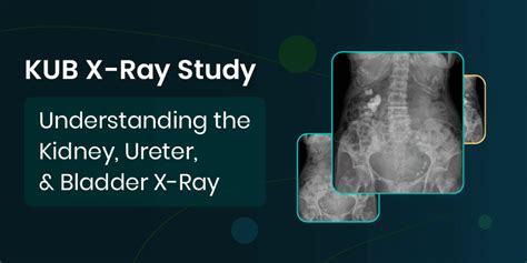 Kub X Ray Study Understanding The Kidney Ureter And Bladder X Ray