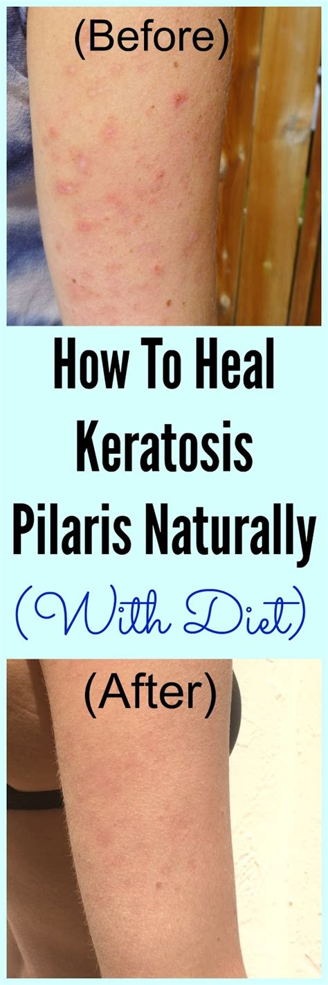 Pure And Simple Nourishment How To Heal Keratosis Pilaris With Diet