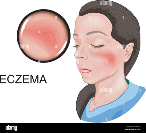 Eczema Vector Vectors High Resolution Stock Photography And Images Alamy