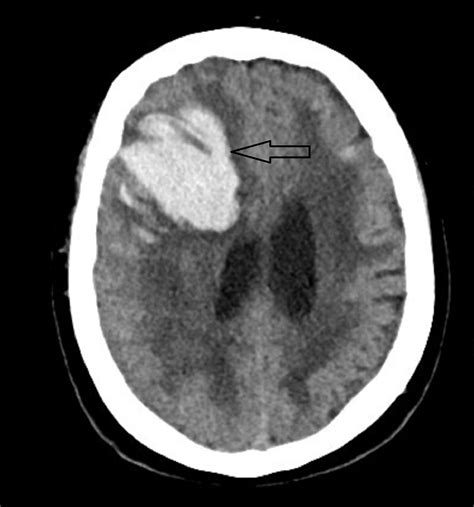 Cureus Does A Spontaneous Intracerebral Hemorrhage Predispose To A