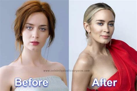 Emily Blunt Plastic Surgery Before And After With Pics