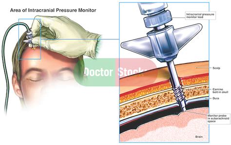 Brain Surgery Placement Of Intracranial Pressure Monitor Doctor Stock