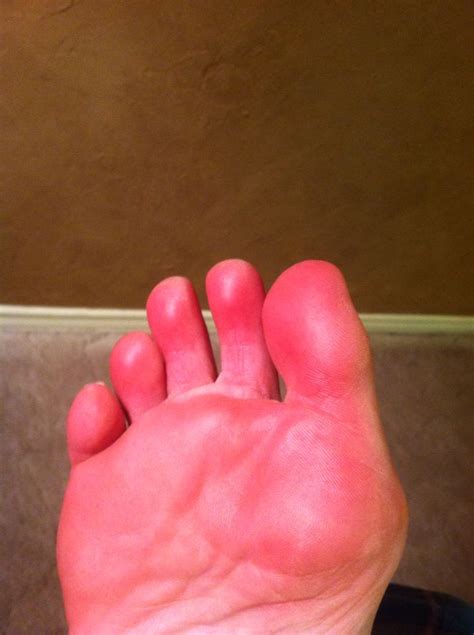 My Foot During An Erythromelalgia Flare Body Awareness Spoonie
