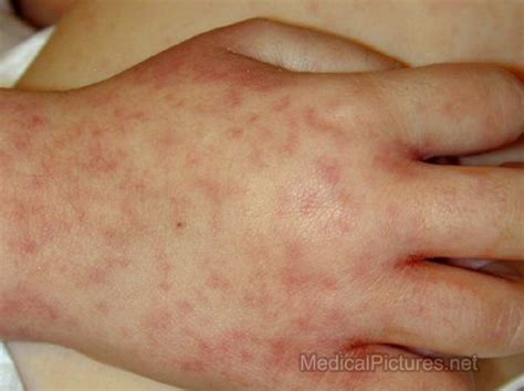 Fifth Disease Pictures