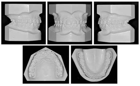 Fig Posttreatment Dental Casts Photographs