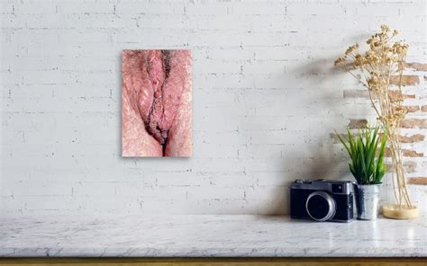 Sebaceous Cysts On Vulva Canvas Print Canvas Art By Dr Hcrobinson
