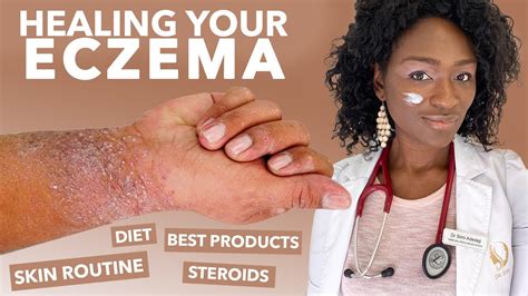 How To Treat Eczema Atopic Dermatitis Black Dark Skin Dry Flaky Skincare Routine