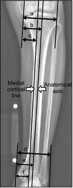 Anatomical Axis And Medial Cortical Line Of The Tibia The Ratios Of