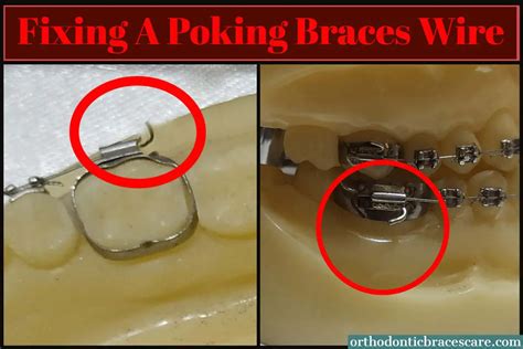 How To Fix A Poking Wire On Braces Orthodontic Braces Care