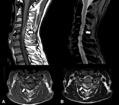 A Case Report An Acute Spinal Epidural Hematoma After Acupuncture