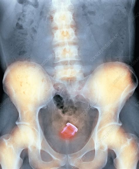 Drinks Bottle In Man S Rectum X Ray Stock Image C007 6061 Science Photo Library