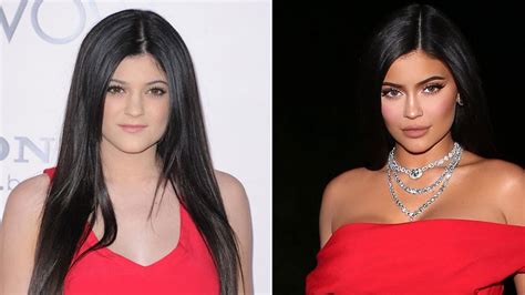 Kylie Jenner El Antes Y El Despu S De Los Retoques Est Ticos