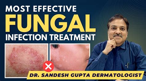 Effective Fungal Infection Treatment By Dermatologist Dr Sandesh
