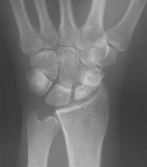 The Assessment And Management Of Acute Scaphoid Fractures My XXX Hot Girl