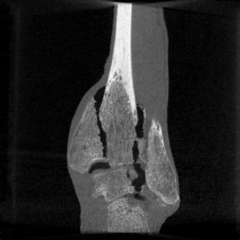 Preview Fracture Of Distal Tibia Left
