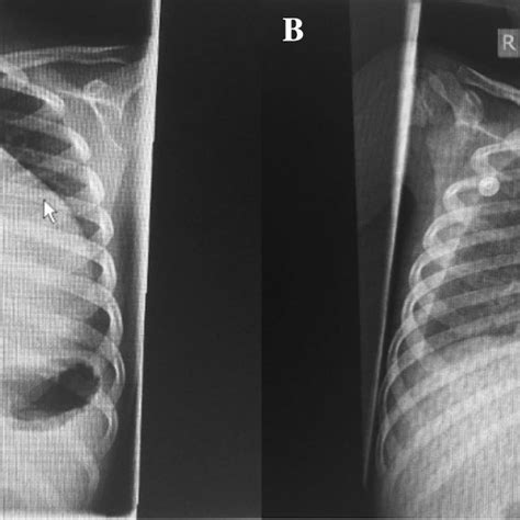 Figure Chest Radiographs Of A Seven Year Old Girl Who Presented With
