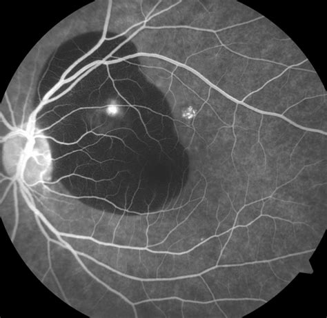How To Interpret Fluorescein Angiography 6 Types Of Defects Eyeguru