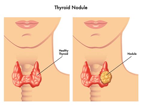 Thyroid Nodule Biopsy And Minimally Invasive Surgery Advanced ENT Allergy Sinus Sleep