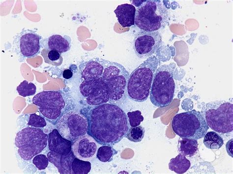 Diffuse Large B Cell Lymphoma Bone Marrow Aspirate 1 B Cell