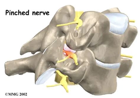 Pinched Nerve In Shoulder Blade Symptoms In Back Under Between