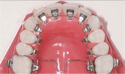 Mit festen zahnspangen lassen sich zähne wesentlich kontrollierter und schneller bewegen als mit die hauptelemente von festen zahnspangen sind bänder, brackets und drähte. Was für verschiedene feste Zahnspangen gibt es? (LOL ...