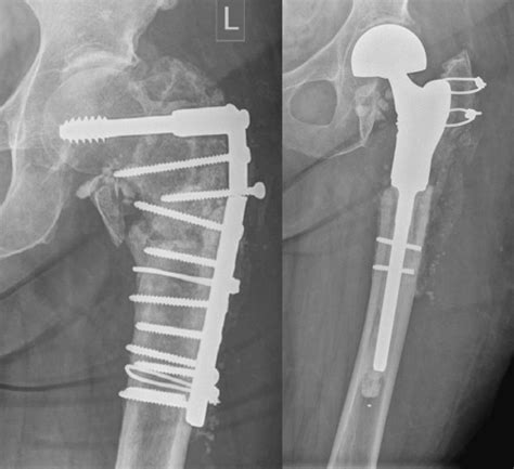 Cemented Proximal Femoral Replacement For The Management Of Non