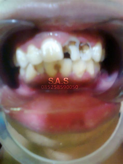 Foto / Gambar Perbaikan Gigi Depan Hitam dan Keropos sebelum dan