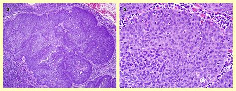 Histopathology Of Human Papillomavirus Related Oropharyngeal Carcinoma